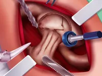 image Princess Hips Surgery
